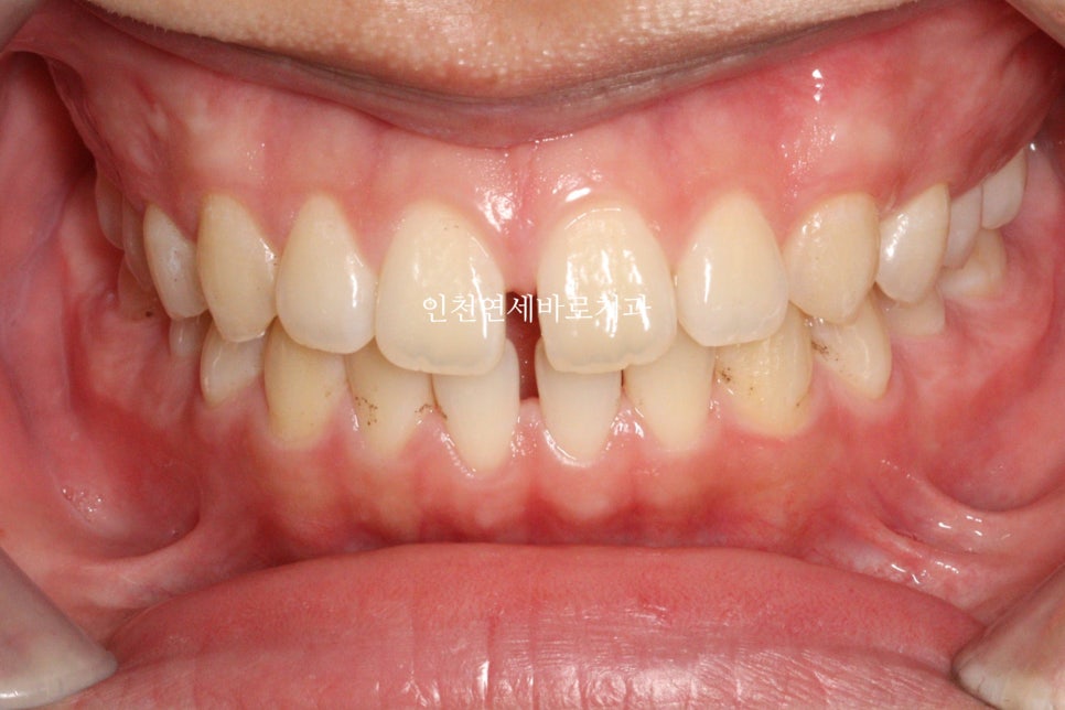 인비절라인 강의 준비하느라 포스팅을 못합니다 인비절라인라이트케이스 하나 공유합니다