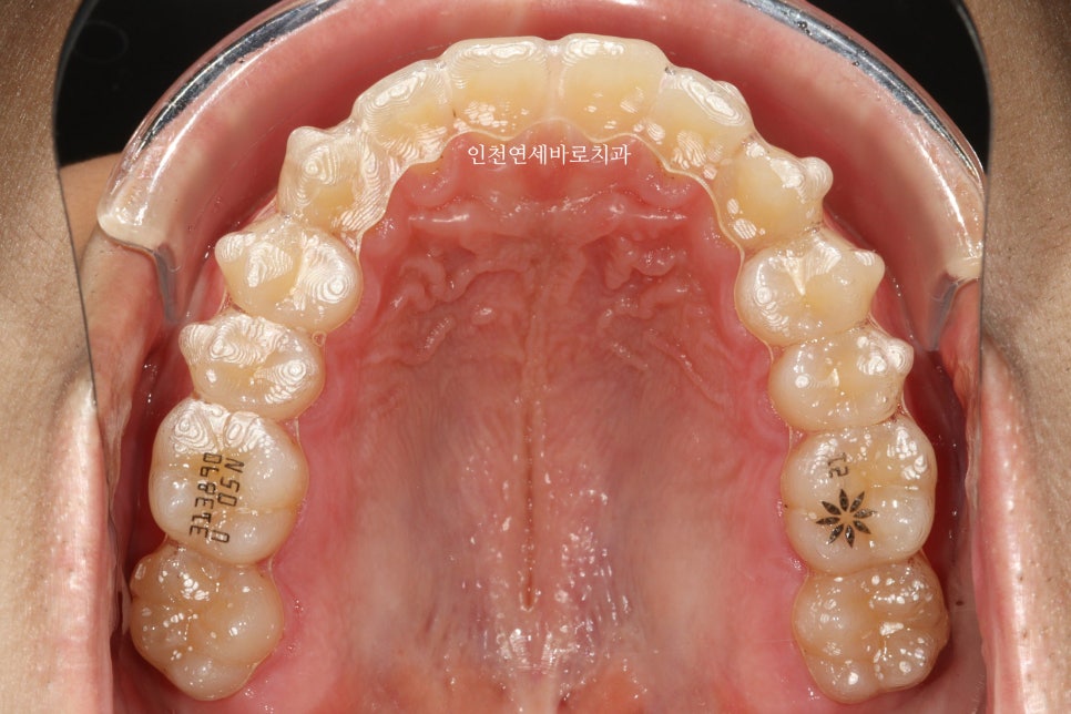 인비절라인 강의 준비하느라 포스팅을 못합니다 인비절라인라이트케이스 하나 공유합니다