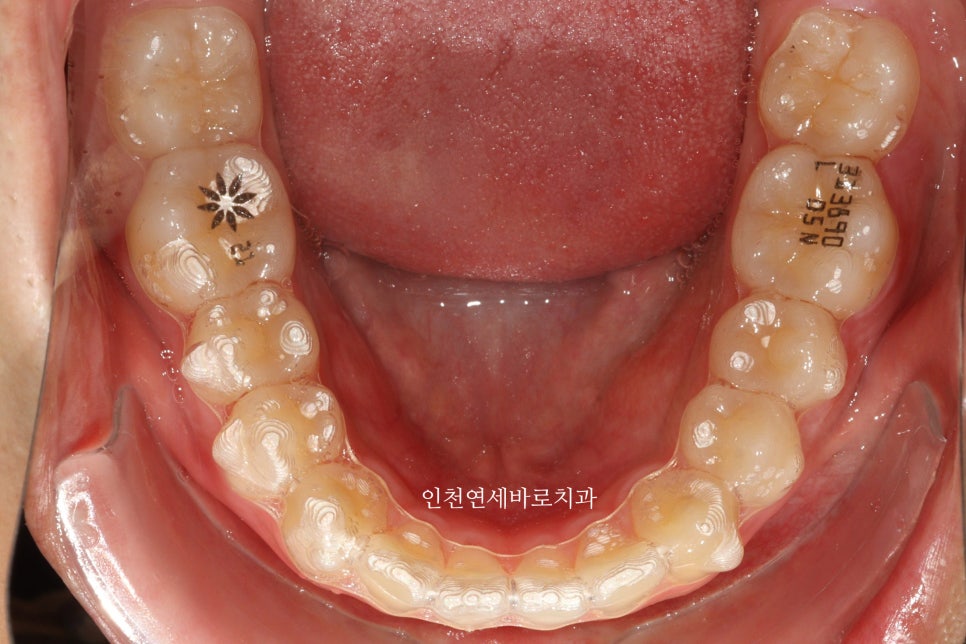 인비절라인 강의 준비하느라 포스팅을 못합니다 인비절라인라이트케이스 하나 공유합니다