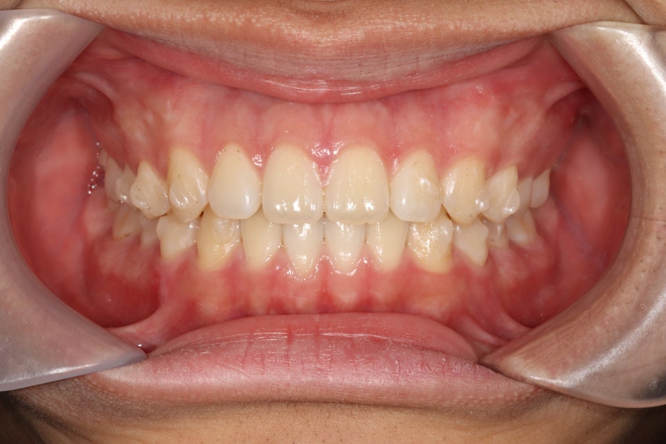 인비절라인 강의 준비하느라 포스팅을 못합니다 인비절라인라이트케이스 하나 공유합니다