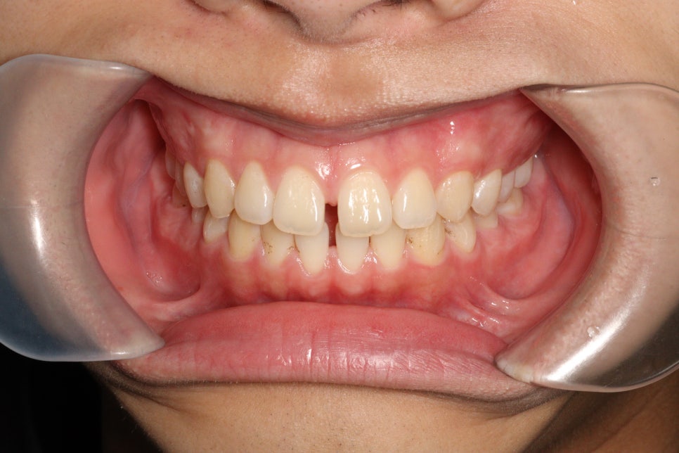 인비절라인 강의 준비하느라 포스팅을 못합니다 인비절라인라이트케이스 하나 공유합니다