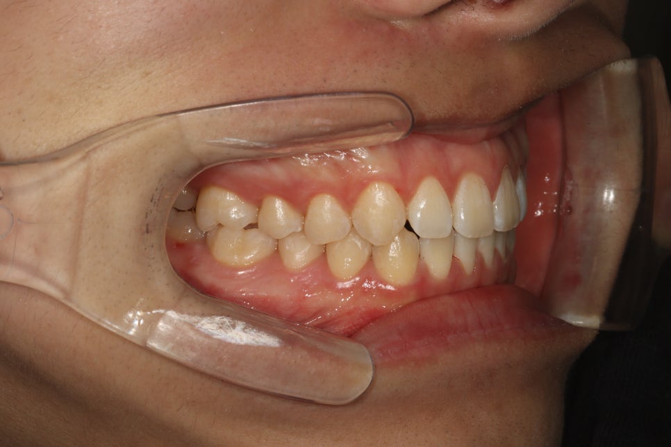 인비절라인 강의 준비하느라 포스팅을 못합니다 인비절라인라이트케이스 하나 공유합니다