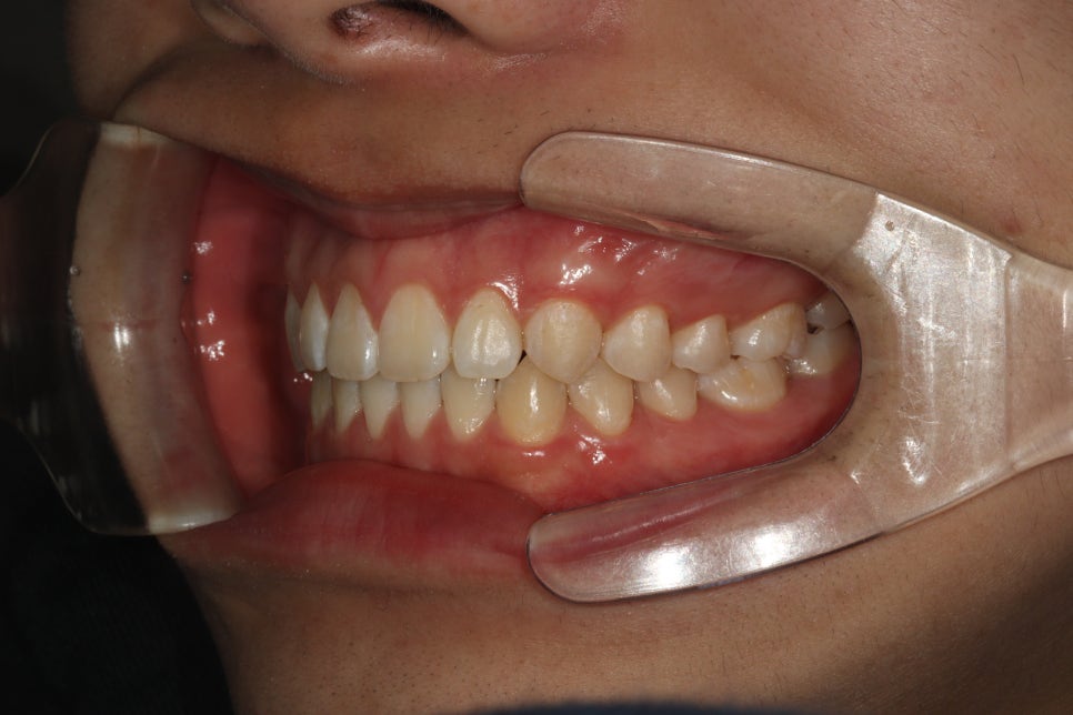 인비절라인 강의 준비하느라 포스팅을 못합니다 인비절라인라이트케이스 하나 공유합니다