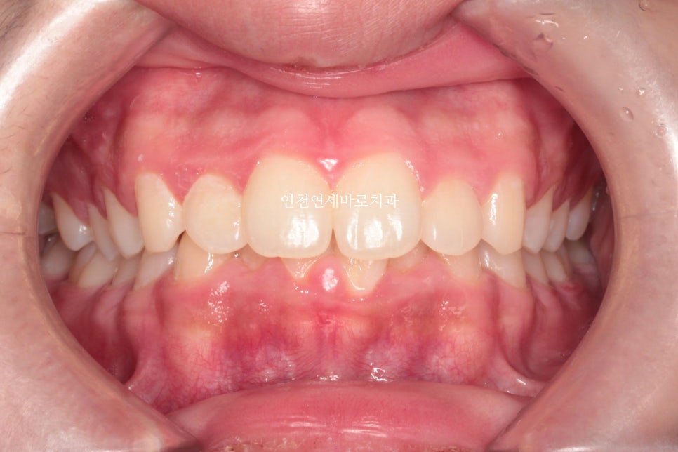인비절라인은 수련의 때 배우는 치료가 아닙니다. 인비절라인 후기기록 겸 알려드리는 정보