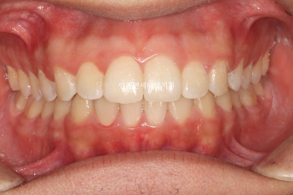 인비절라인은 수련의 때 배우는 치료가 아닙니다. 인비절라인 후기기록 겸 알려드리는 정보