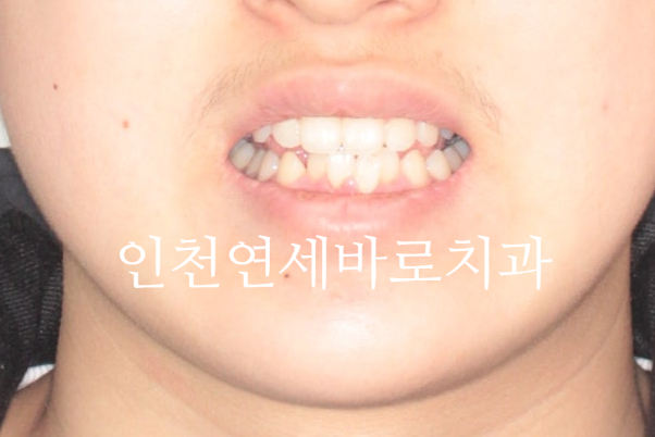 인비절라인은 수련의 때 배우는 치료가 아닙니다. 인비절라인 후기기록 겸 알려드리는 정보