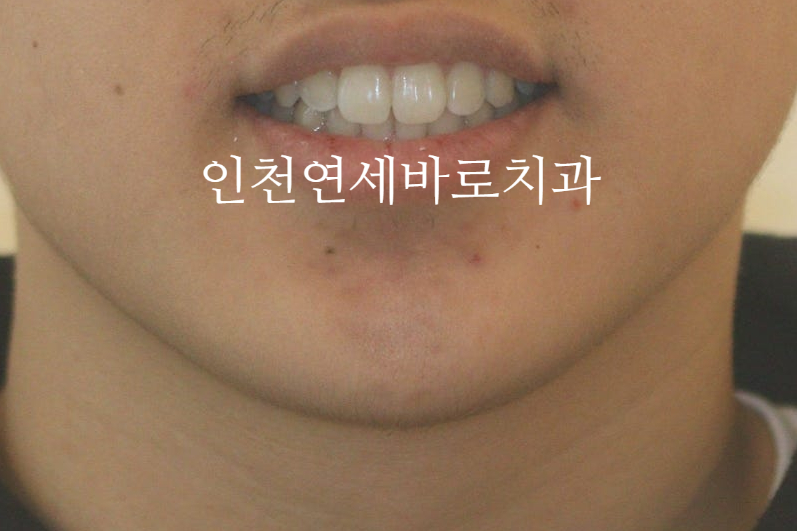 인비절라인은 수련의 때 배우는 치료가 아닙니다. 인비절라인 후기기록 겸 알려드리는 정보