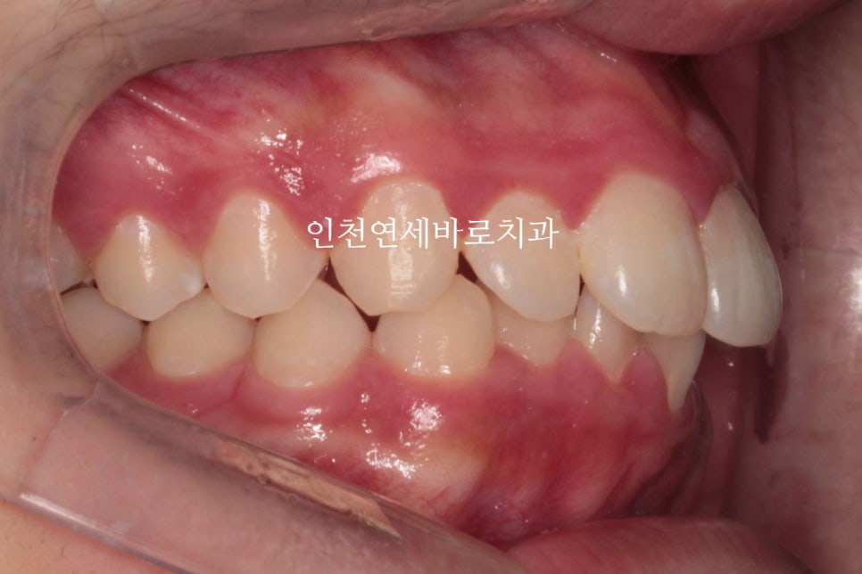 인비절라인은 수련의 때 배우는 치료가 아닙니다. 인비절라인 후기기록 겸 알려드리는 정보