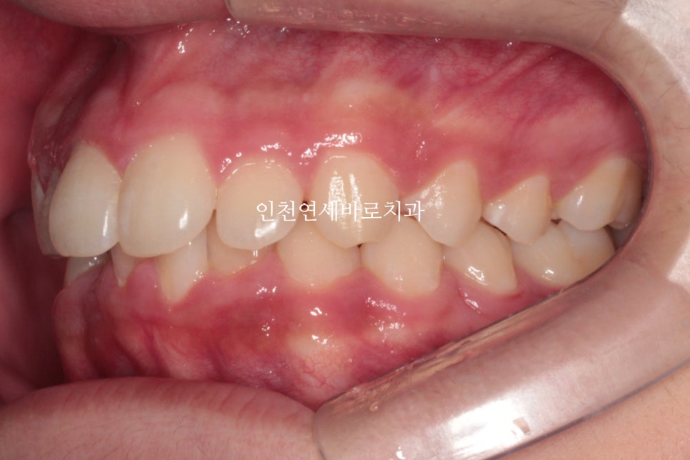 인비절라인은 수련의 때 배우는 치료가 아닙니다. 인비절라인 후기기록 겸 알려드리는 정보