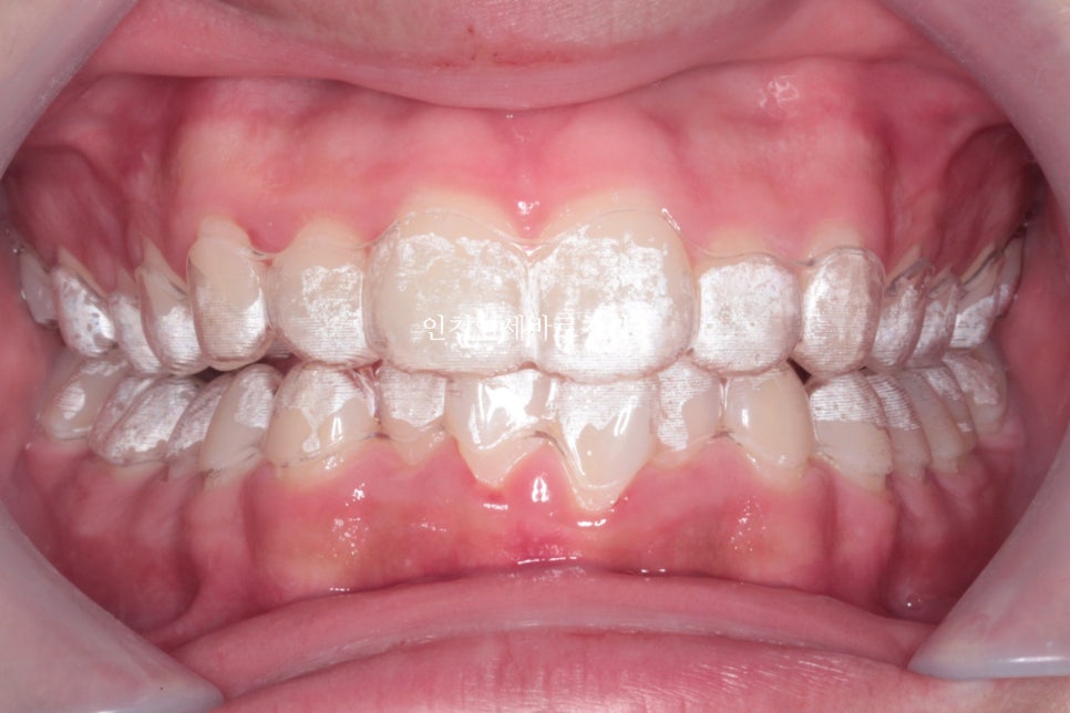 인비절라인은 수련의 때 배우는 치료가 아닙니다. 인비절라인 후기기록 겸 알려드리는 정보