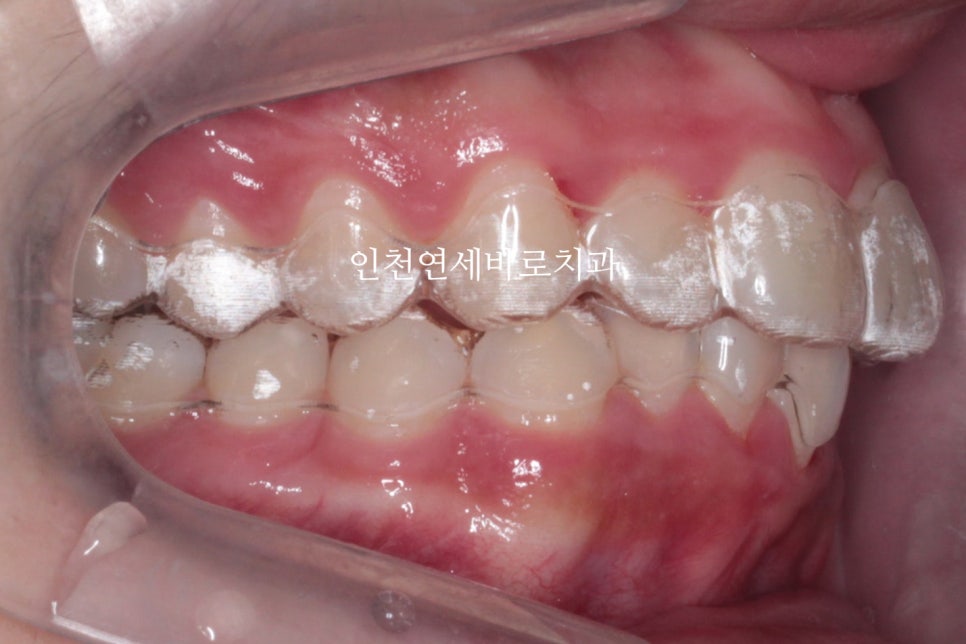 인비절라인은 수련의 때 배우는 치료가 아닙니다. 인비절라인 후기기록 겸 알려드리는 정보