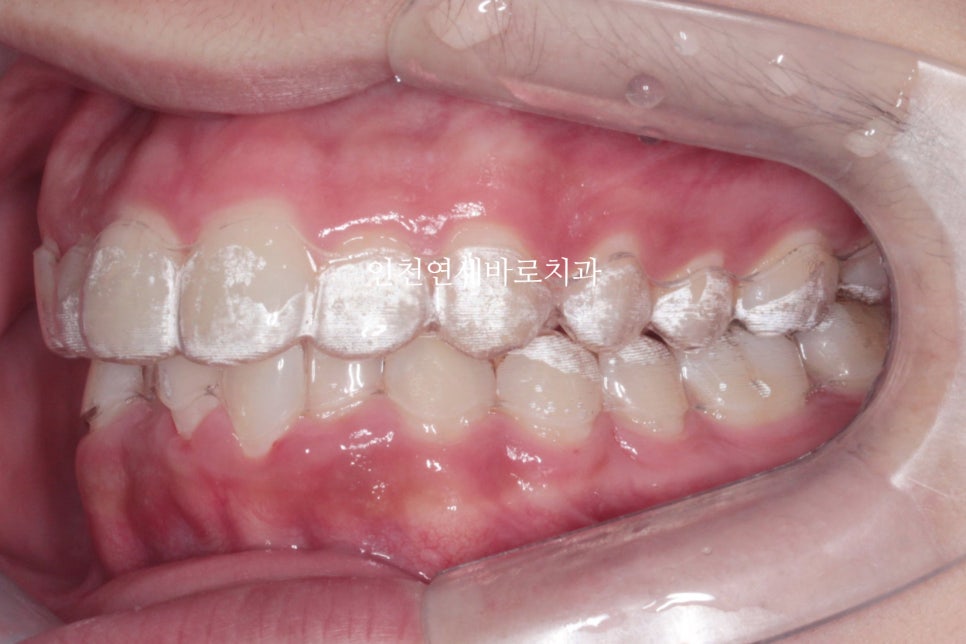 인비절라인은 수련의 때 배우는 치료가 아닙니다. 인비절라인 후기기록 겸 알려드리는 정보