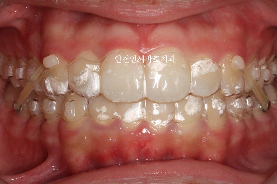 인비절라인은 수련의 때 배우는 치료가 아닙니다. 인비절라인 후기기록 겸 알려드리는 정보