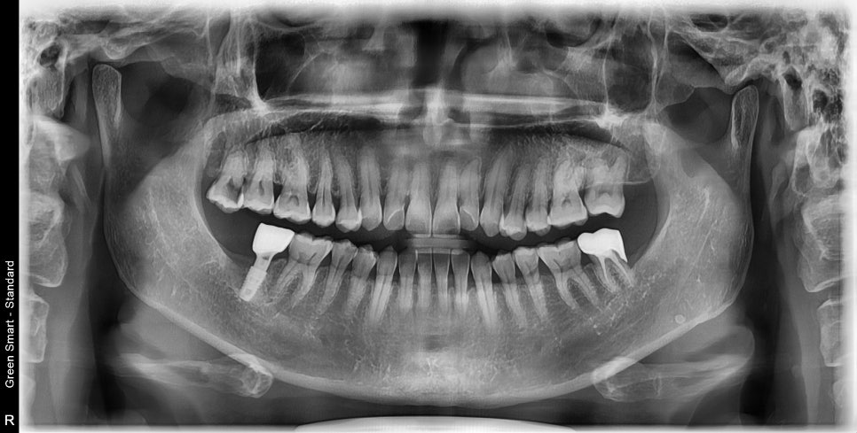 50대 치아하나 움직이는데 3년걸린 치아교정 이야기