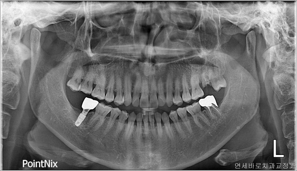 50대 치아하나 움직이는데 3년걸린 치아교정 이야기