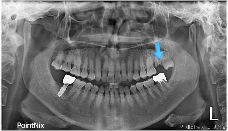 50대 치아하나 움직이는데 3년걸린 치아교정 이야기