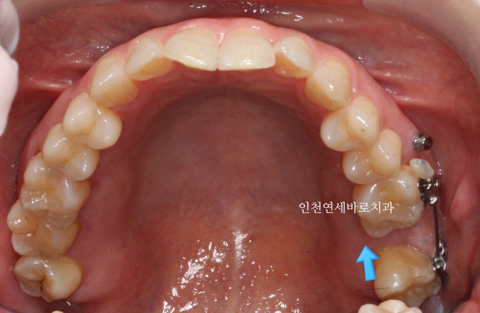 50대 치아하나 움직이는데 3년걸린 치아교정 이야기