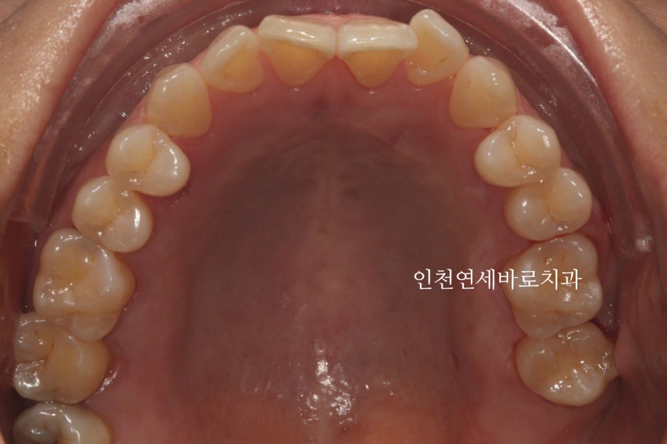 50대 치아하나 움직이는데 3년걸린 치아교정 이야기