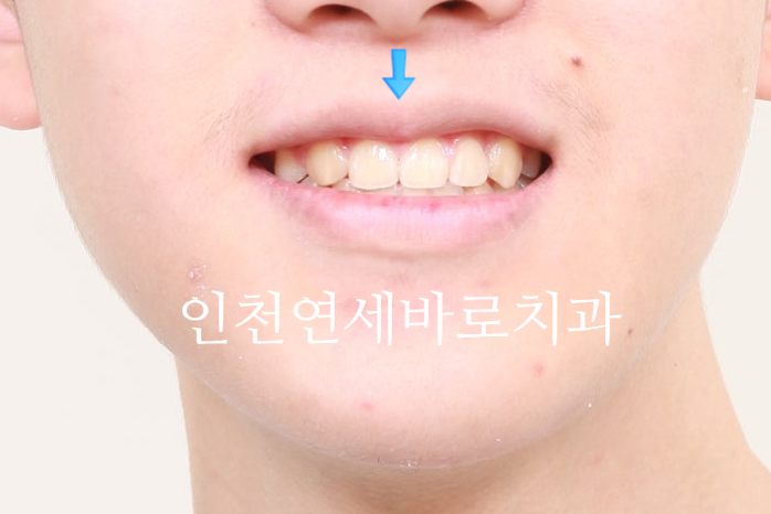 결손치아 티안나게, 임플란트없이 교정치료로 마무리 후기 기록