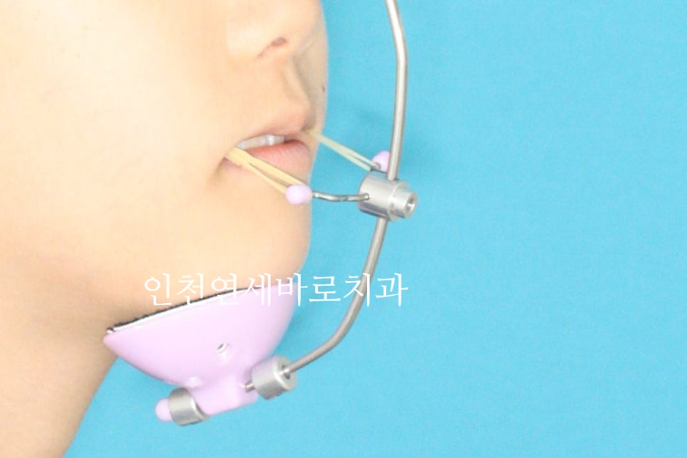 결손치아 티안나게, 임플란트없이 교정치료로 마무리 후기 기록