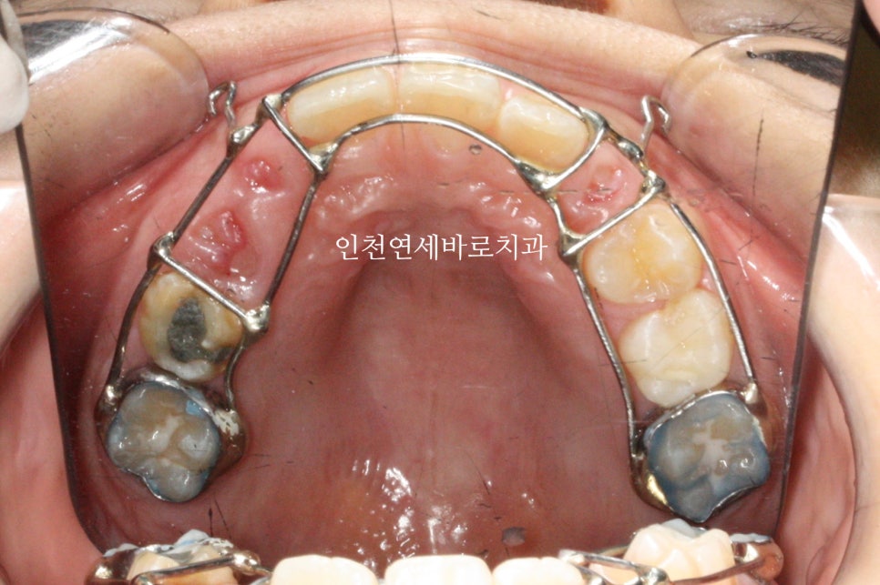 결손치아 티안나게, 임플란트없이 교정치료로 마무리 후기 기록