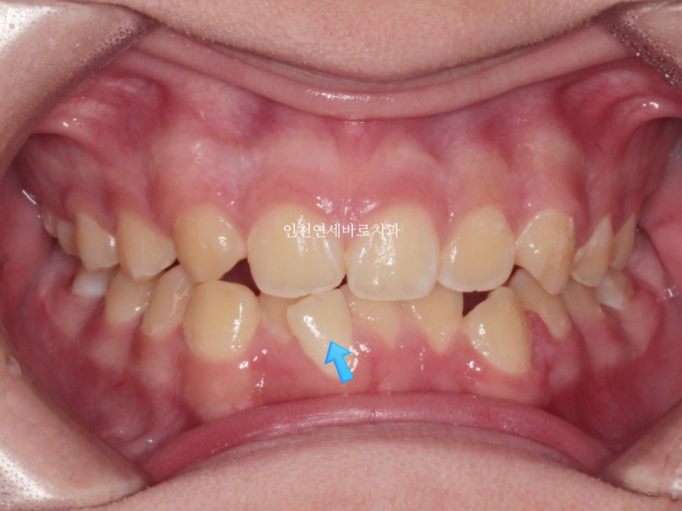 결손치아 티안나게, 임플란트없이 교정치료로 마무리 후기 기록