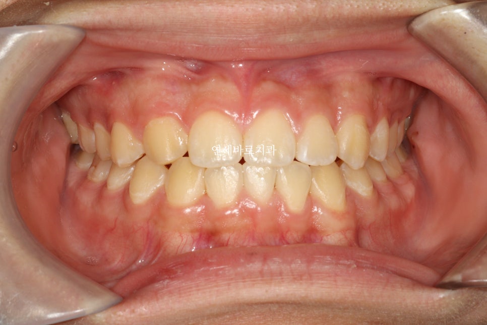 결손치아 티안나게, 임플란트없이 교정치료로 마무리 후기 기록