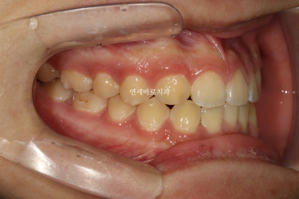 결손치아 티안나게, 임플란트없이 교정치료로 마무리 후기 기록