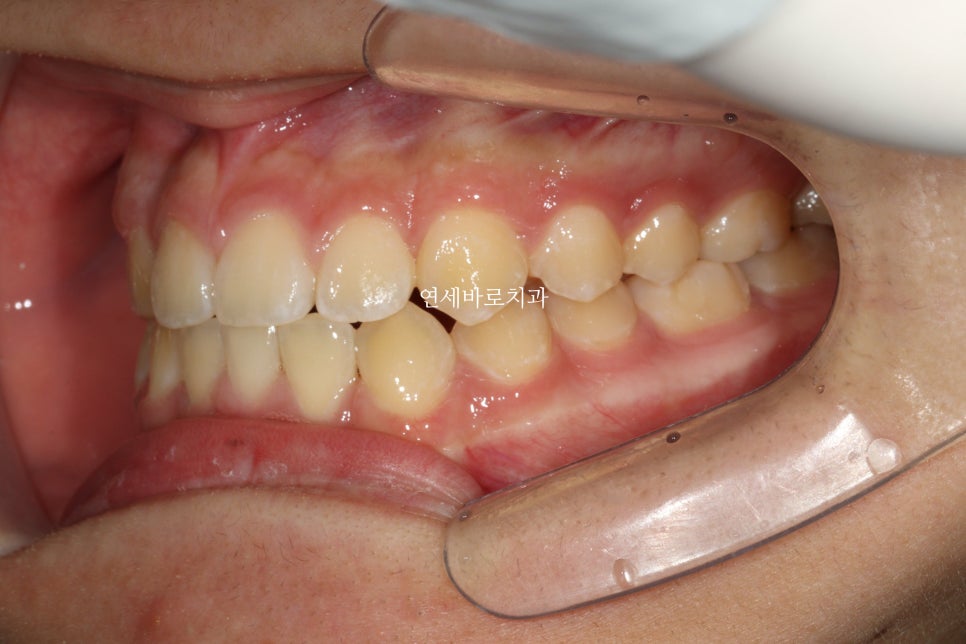 결손치아 티안나게, 임플란트없이 교정치료로 마무리 후기 기록