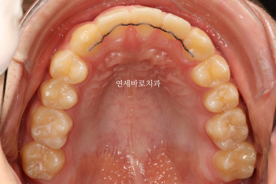 결손치아 티안나게, 임플란트없이 교정치료로 마무리 후기 기록