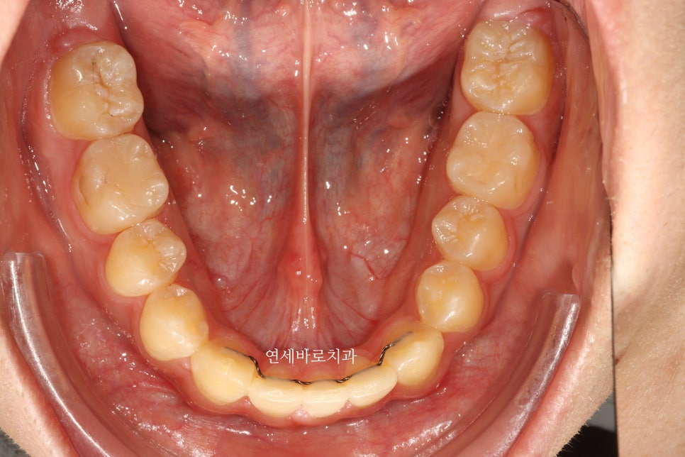 결손치아 티안나게, 임플란트없이 교정치료로 마무리 후기 기록