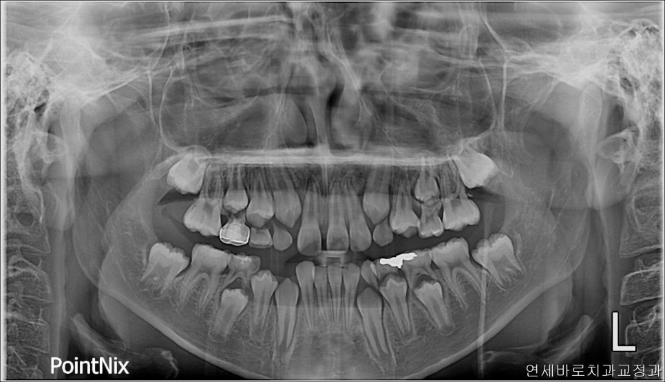 결손치아 티안나게, 임플란트없이 교정치료로 마무리 후기 기록