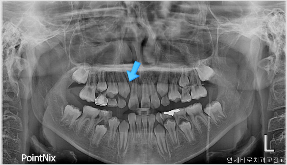 결손치아 티안나게, 임플란트없이 교정치료로 마무리 후기 기록