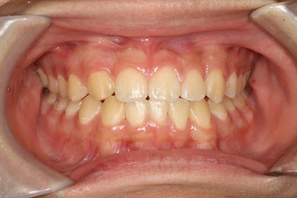 결손치아 티안나게, 임플란트없이 교정치료로 마무리 후기 기록