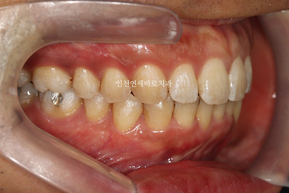 인비절라인 과개교합, 뻗친 치아 비발치 치료 후기 치료기간 1년