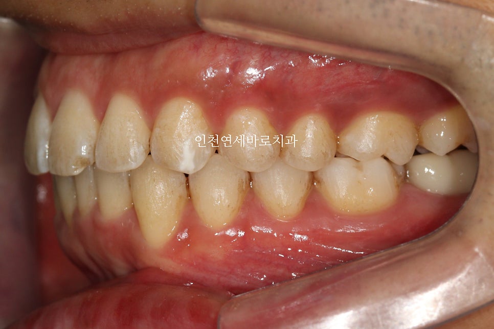 인비절라인 과개교합, 뻗친 치아 비발치 치료 후기 치료기간 1년