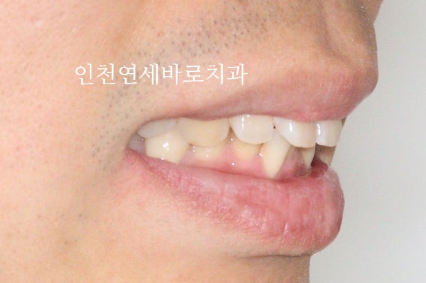 인비절라인 과개교합, 뻗친 치아 비발치 치료 후기 치료기간 1년