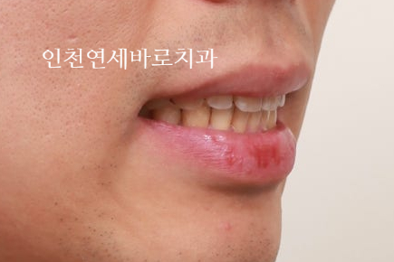 인비절라인 과개교합, 뻗친 치아 비발치 치료 후기 치료기간 1년