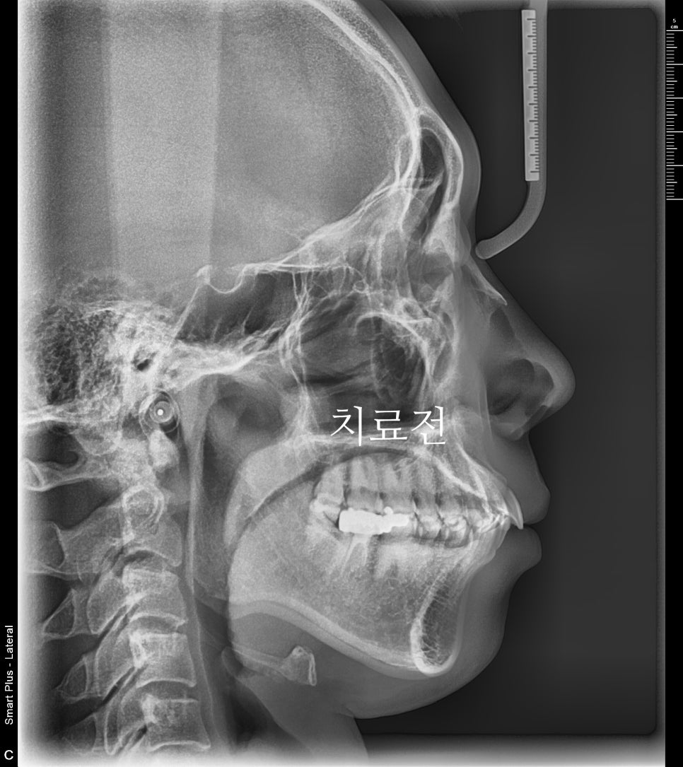 인비절라인 과개교합, 뻗친 치아 비발치 치료 후기 치료기간 1년