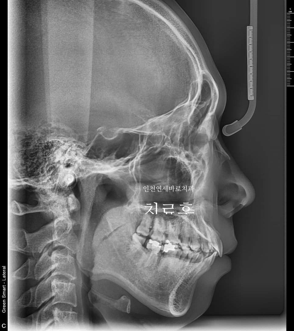 인비절라인 과개교합, 뻗친 치아 비발치 치료 후기 치료기간 1년