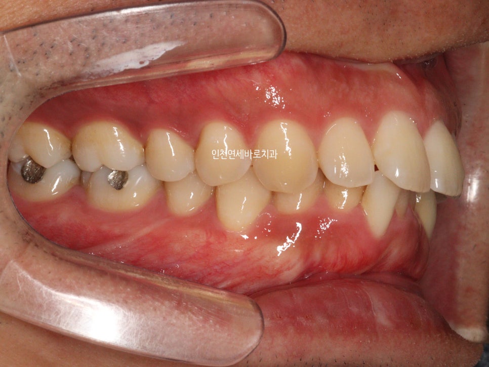 인비절라인 과개교합, 뻗친 치아 비발치 치료 후기 치료기간 1년