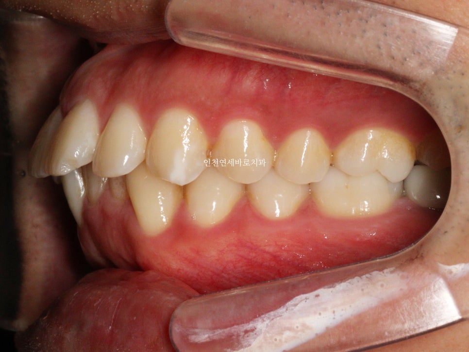 인비절라인 과개교합, 뻗친 치아 비발치 치료 후기 치료기간 1년