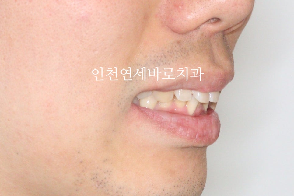 인비절라인 과개교합, 뻗친 치아 비발치 치료 후기 치료기간 1년