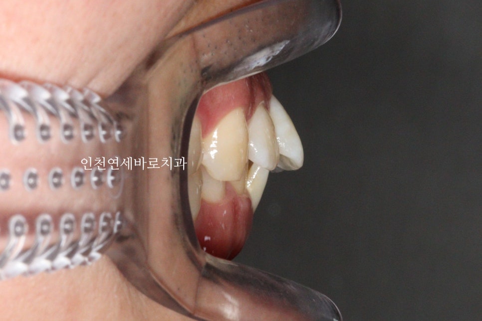 인비절라인 과개교합, 뻗친 치아 비발치 치료 후기 치료기간 1년
