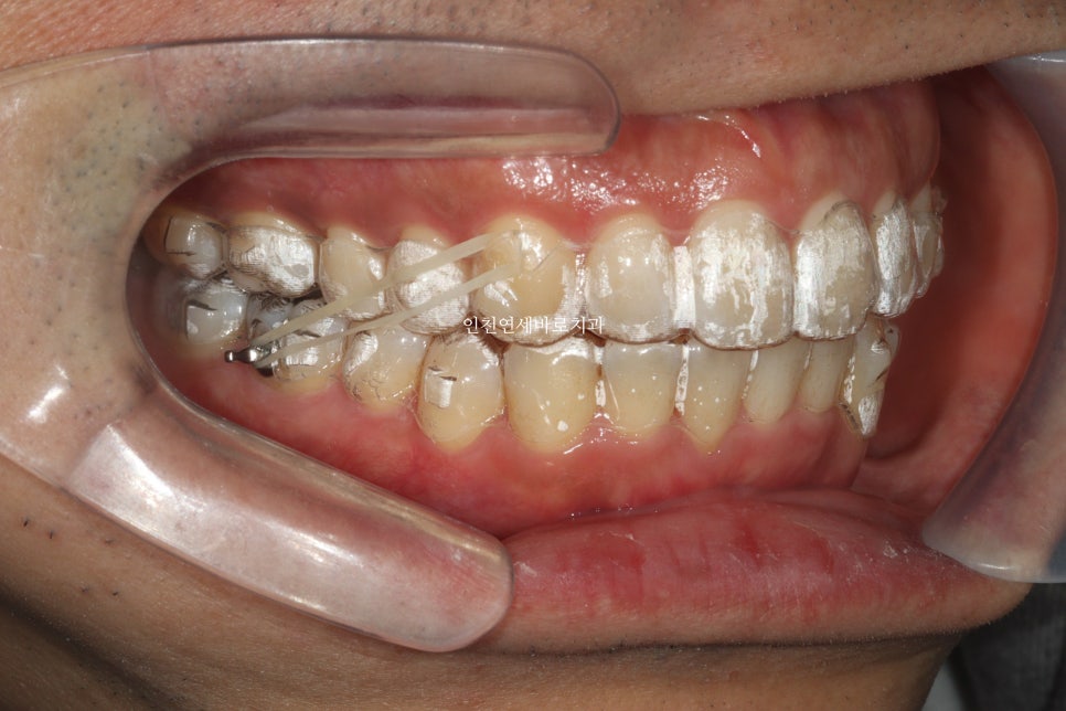 인비절라인 과개교합, 뻗친 치아 비발치 치료 후기 치료기간 1년