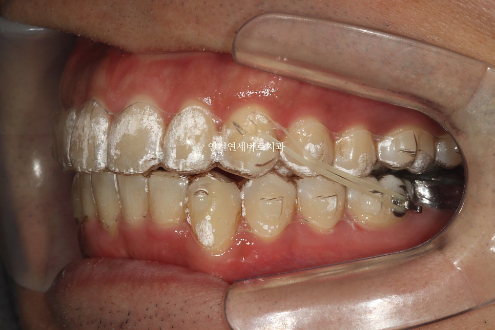 인비절라인 과개교합, 뻗친 치아 비발치 치료 후기 치료기간 1년