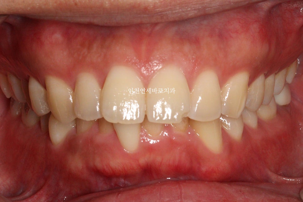인비절라인 과개교합, 뻗친 치아 비발치 치료 후기 치료기간 1년