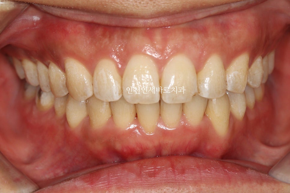 인비절라인 과개교합, 뻗친 치아 비발치 치료 후기 치료기간 1년