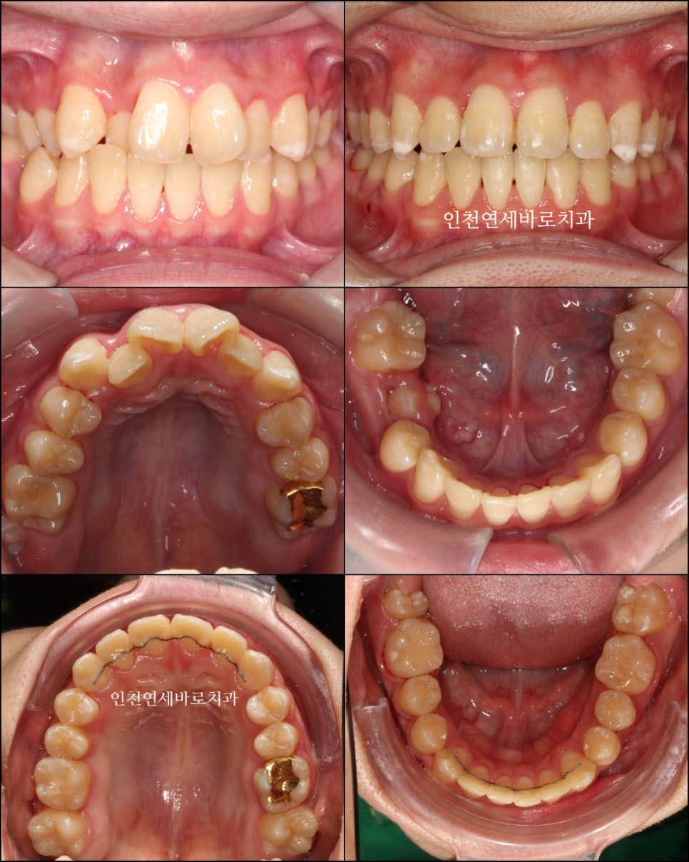 철사교정 끝나고도 비베라 vivera 가능할까?