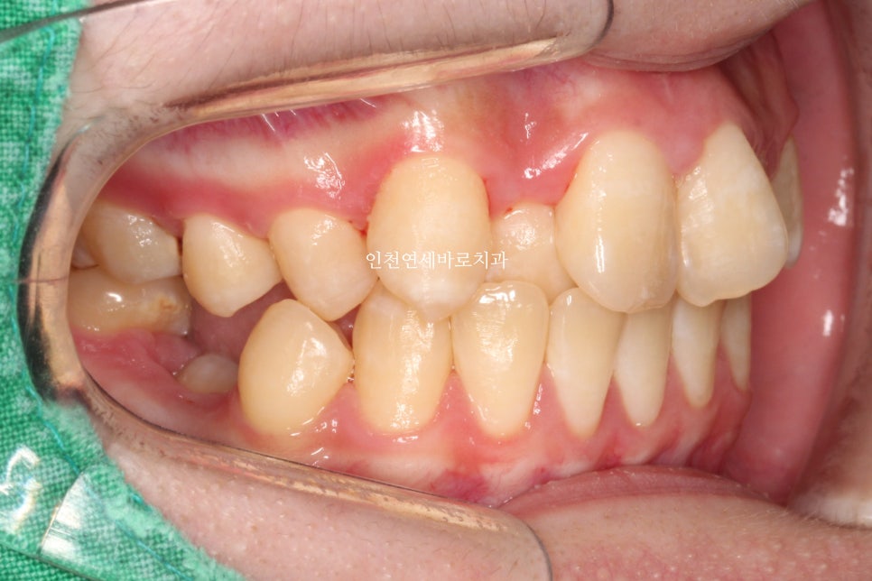 철사교정 끝나고도 비베라 vivera 가능할까?